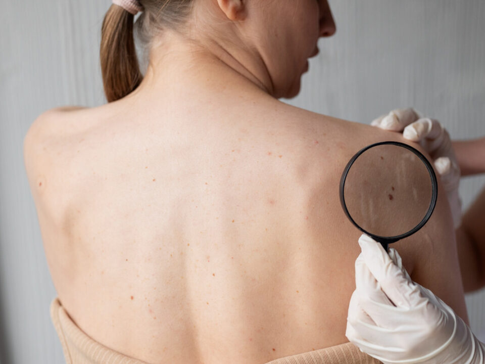 Orvos melanómát diagnosztizál egy nőbeteg testén
