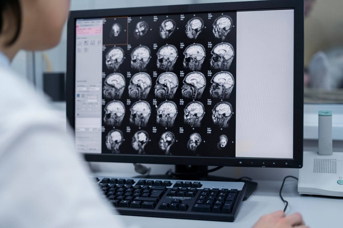 Agyvérzés és stroke felismerése CT vizsgálattal