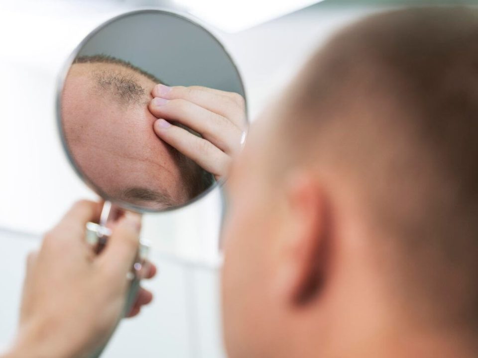 A fejbőr-psoriasis az egyik leggyakoribb krónikus bőrbetegség, amely nemcsak esztétikai problémát jelent, hanem komoly fizikai és lelki terhet is róhat az érintettekre.
