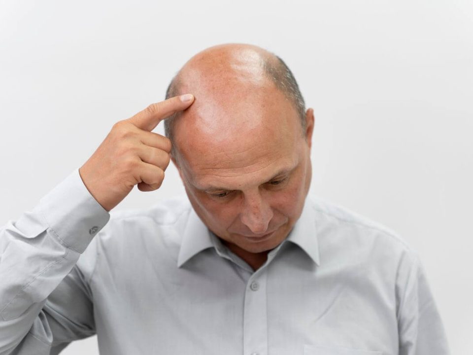 Az androgén alopecia férfiaknál a hajhullás leggyakoribb formája, amely világszerte több százmillió férfit érint