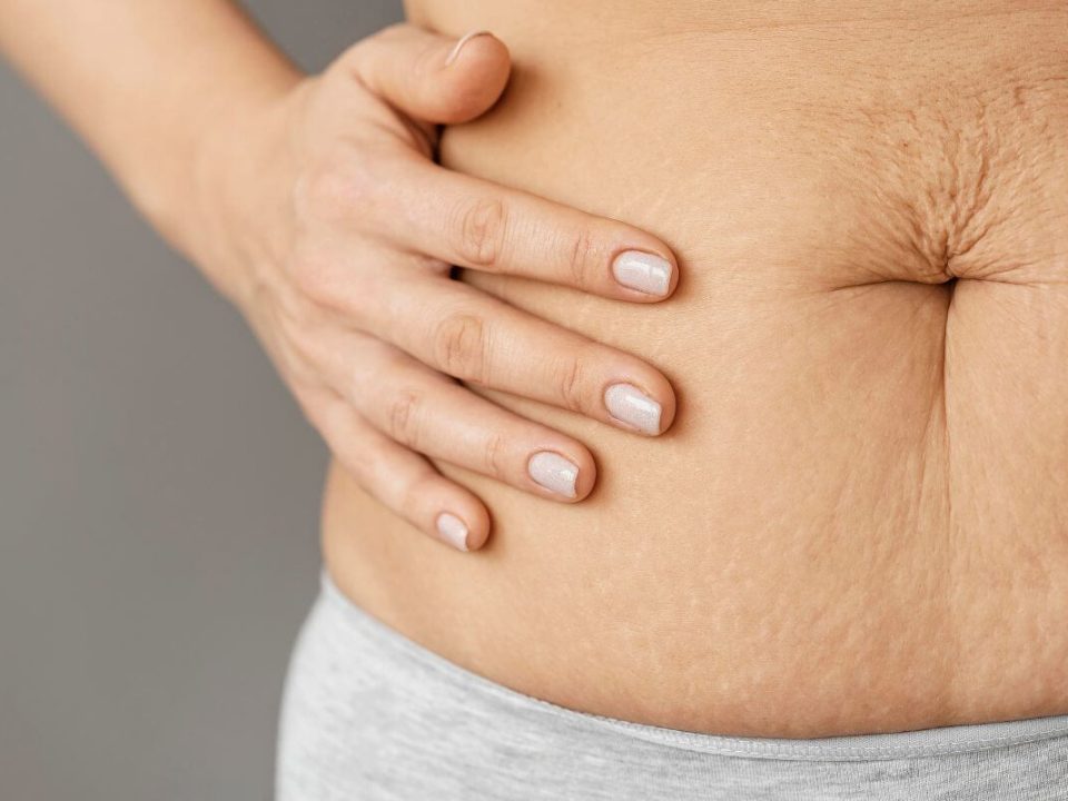 Az elhízás a szervezet egészére kihat, és gyakran a bőrön jelennek meg az első árulkodó jelek.